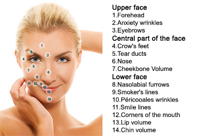 Injection-areas-hyaluronic-acid-face